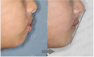 哪些明星正畸,揭秘那些笑得更自信的璀璨面孔